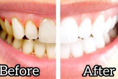 8 Cara Membersihkan Karang Gigi Cukup Hanya Dengan di Rumah Saja, Mudah dan Anti Ribet!