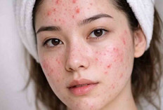 Kulit Wajah Jerawatan, Ini Cara Perawatan yang Tepat 