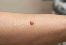 Daging Tumbuh atau Tumor, Ini Perbedaannya 