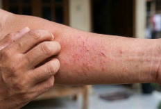 Kenali Perbedaan Gatal Biasa dengan Gatal Karena Gangguan Ginjal 