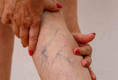 Kenali 5 Perbedaan Varises dan Urat Biasa 