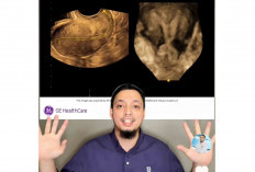 Kondisi Rahim Seperti Ada Tanduk ? Ini Resikonya saat Terjadi Kehamilan 