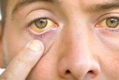 Mata Kuning pada Remaja, Ternyata Gejala Serius yang Tak Boleh Diabaikan