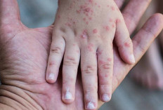 Waspada Kasus Campak Pada Anak, Ini Gejala dan Cara Pencegahannya