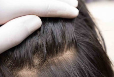 Hilangkan Kutu Rambut Bisa dengan Garam, Ini Penjelasannya
