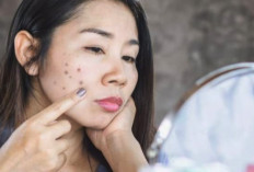 Kenali 7 Ciri-ciri Produk Skincare Tidak Cocok Untuk Kulitmu, Bikin Kulit Jadi Mudah Jerawatan