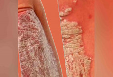 Kulit bersisik dan gatal Bisa jadi Psoriasis. Ini Gejala dan Cara Mencegahnya 