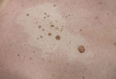 Keratosis Seboroik atau Kelainan pada Kulit. Segera Periksa ke Dokter Jika Ada Tanda Ini 