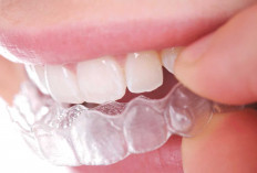 Pentingnya Memakai Retainer Setelah Lepas Behel: Jangan Abaikan Langkah Ini