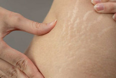 Ini Perbedaan Seluit dan Stetch Mark dan Cara Mengatasinya