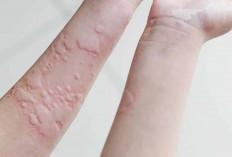 Ini Penyebab Kaligata atau Biduran dan Cara Mengatasinya 