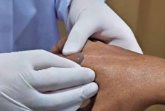 Waspada Scabies, Gatal Hebat Karena Tungau Sarcoptes Scabie