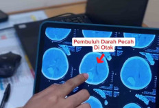 Pecah Pembuluh Darah, Ini Penyebabnya 