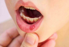3 Bahan Alami Ampuh Usir Sariawan, Coba Deh!