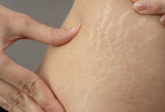 Inilah 7 Cara Menghilangkan Stretch Mark Secara Alami dan Medis