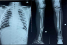 Abbad Atlet Cidera Parah Diturnamen PGRI Lubuk Linggau Tetap Optimis Bisa Jadi Pemain Bola Profesional