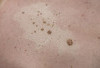 Keratosis Seboroik atau Kelainan pada Kulit. Segera Periksa ke Dokter Jika Ada Tanda Ini 